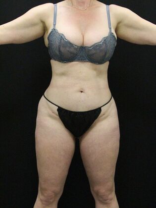 Liposuction: Case 29 - After