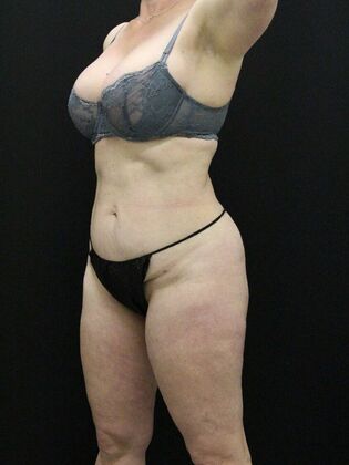 Liposuction Case 29 - After