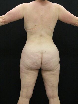 Liposuction: Case 29 - After