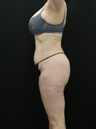 Liposuction: Case 29 - After