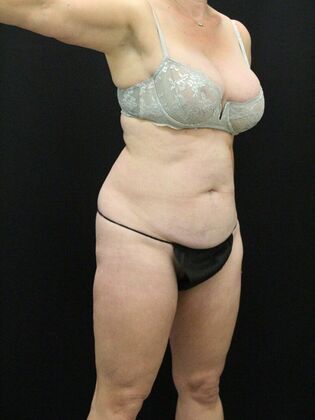 Liposuction: Case 29 - Before