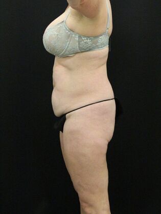 Liposuction: Case 29 - Before