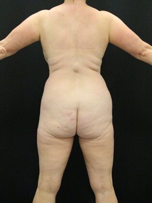 Liposuction: Case 29 - Before