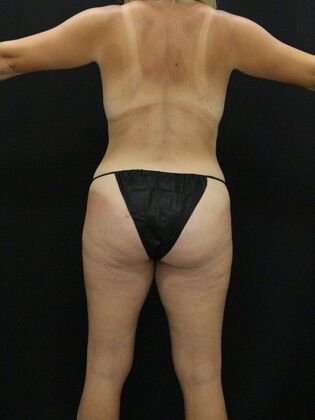 Tummy Tuck: Case 33 - After