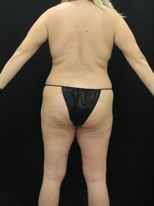 Tummy Tuck: Case 33 - Before