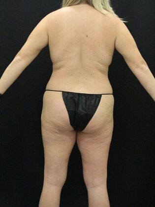 Liposuction Case 30 - Before