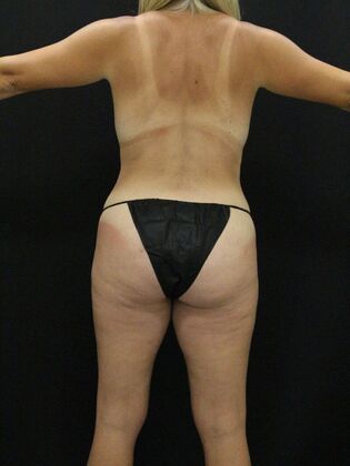 Liposuction Case 30 - After