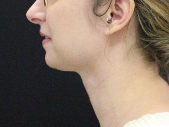 Liposuction Case 31 - After