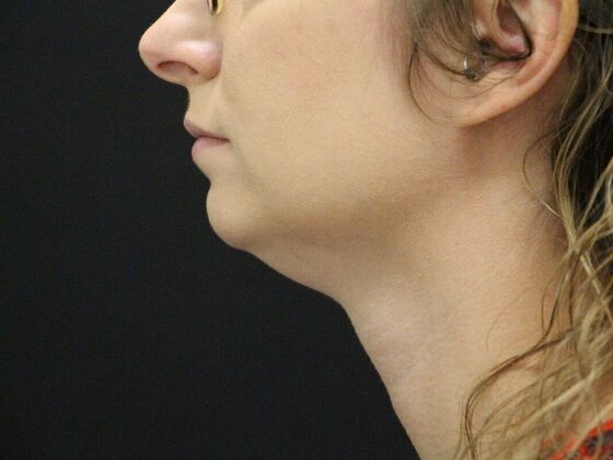 Liposuction Case 31 - Before