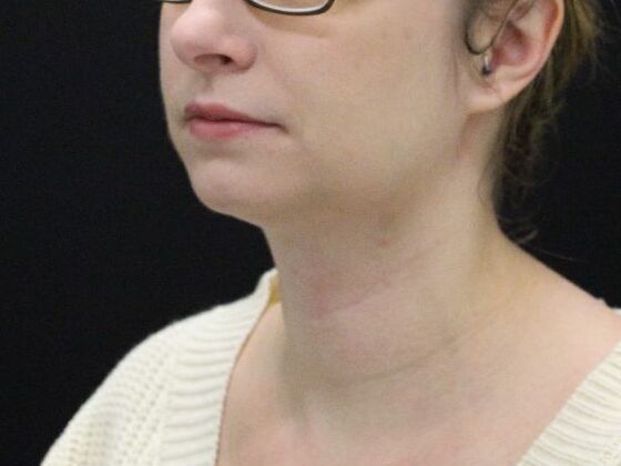 Liposuction: Case 31 - After