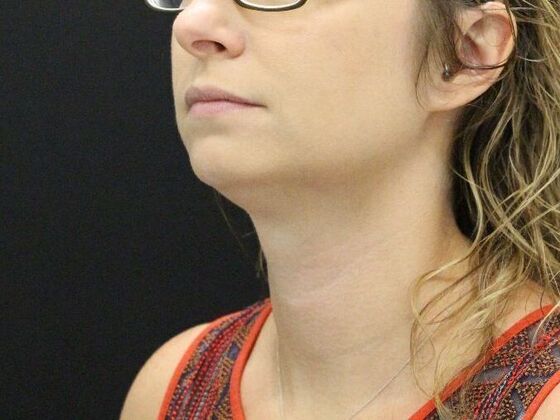 Liposuction: Case 31 - Before