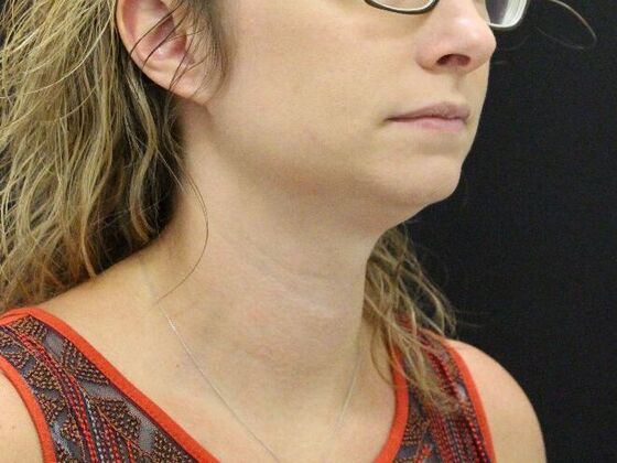 Liposuction: Case 31 - Before