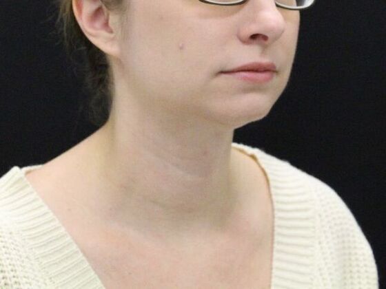 Liposuction: Case 31 - After