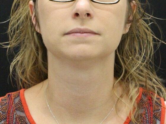 Liposuction: Case 31 - Before