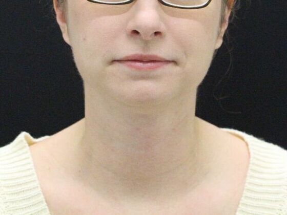 Liposuction: Case 31 - After