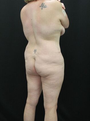 Brazilian Butt Lift: Case 2 - Before