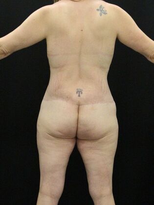 Brazilian Butt Lift Case 2 - After