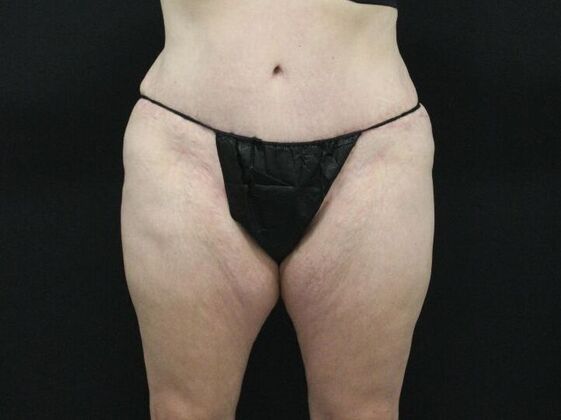 Thigh Lift & Reduction Case 7 - Before