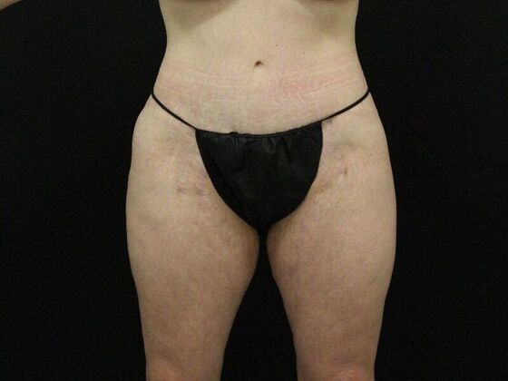 Thigh Lift & Reduction Case 7 - After