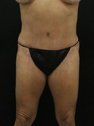 Tummy Tuck: Case 34 - After