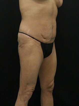 Tummy Tuck: Case 34 - Before