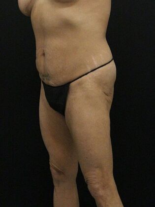 Tummy Tuck Case 34 - Before