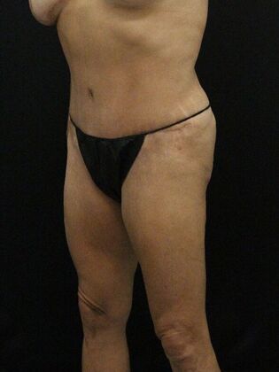 Tummy Tuck Case 34 - After