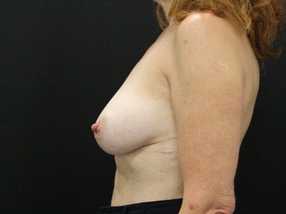 Breast Revision: Case 7 - After