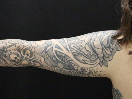 Arm Lift & Reduction: Case 9 - Before