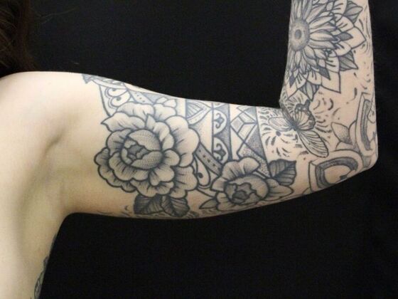 Arm Lift & Reduction: Case 9 - Before