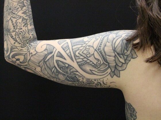 Arm Lift & Reduction: Case 9 - Before