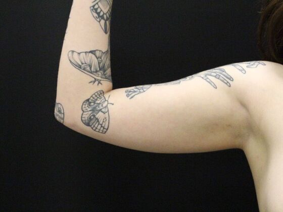 Arm Lift & Reduction Case 9 - Before