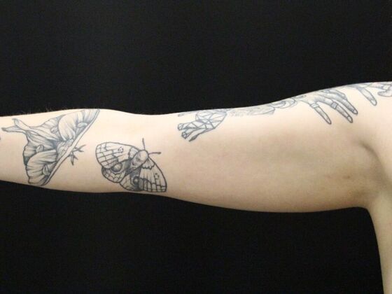 Arm Lift & Reduction: Case 9 - Before