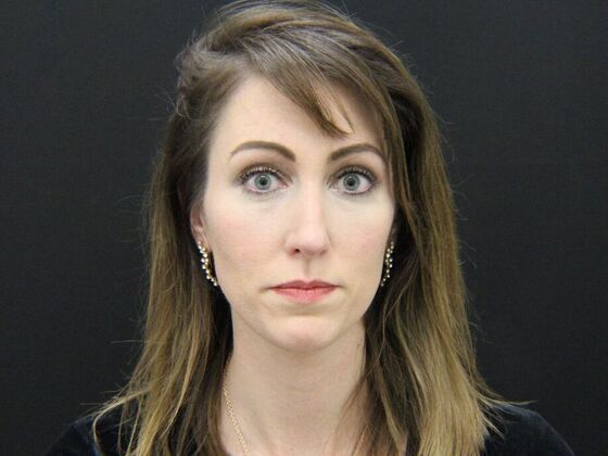 Rhinoplasty: Case 1 - Before