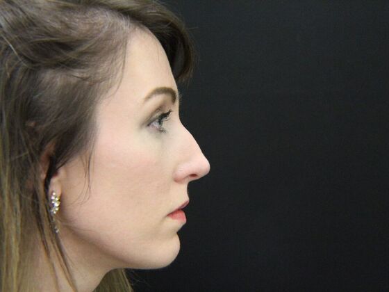 Rhinoplasty Case 1 - Before