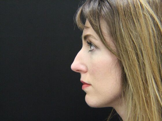 Rhinoplasty: Case 1 - Before