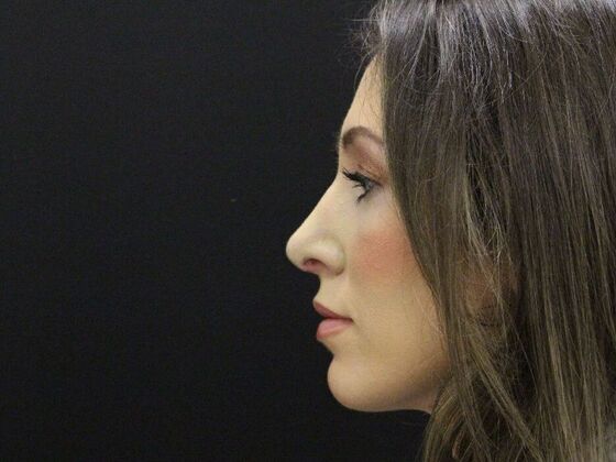 Rhinoplasty: Case 1 - After