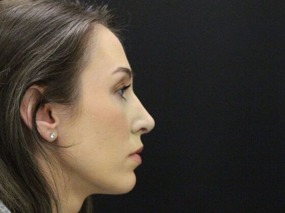 Rhinoplasty Case 1 - After