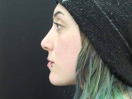 Rhinoplasty: Case 2 - After