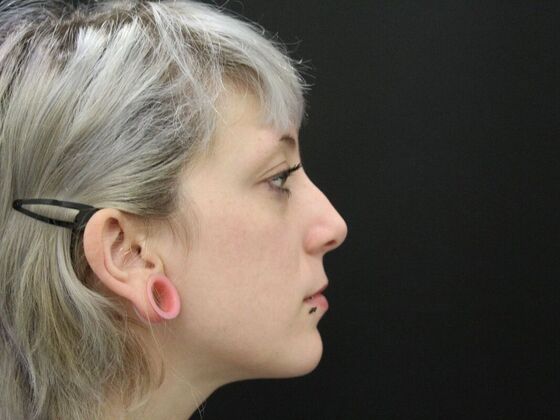 Rhinoplasty Case 2 - Before