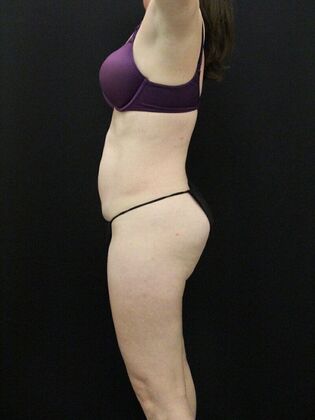 Tummy Tuck: Case 35 - Before