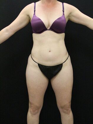 Tummy Tuck: Case 35 - Before