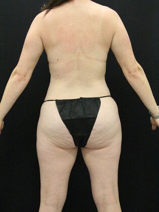 Tummy Tuck: Case 35 - Before