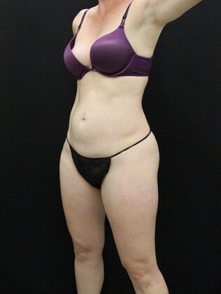 Tummy Tuck Case 35 - Before
