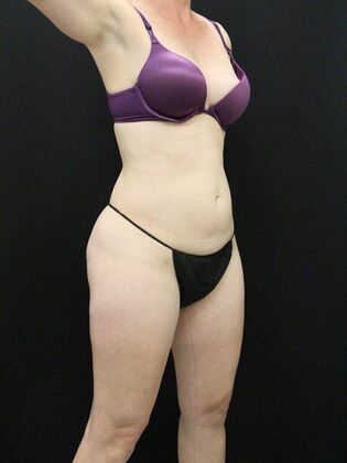 Tummy Tuck: Case 35 - Before