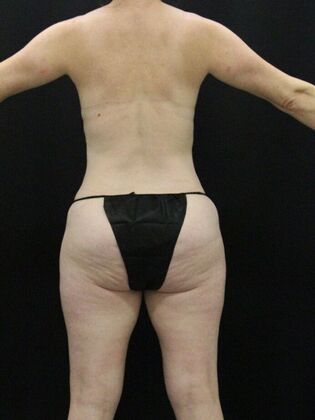 Tummy Tuck: Case 35 - After