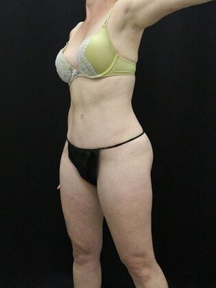 Tummy Tuck Case 35 - After