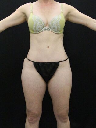 Tummy Tuck: Case 35 - After