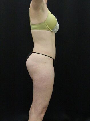 Tummy Tuck: Case 35 - After