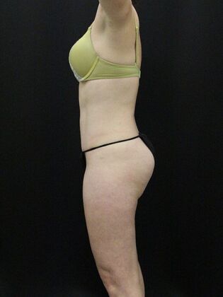 Tummy Tuck: Case 35 - After